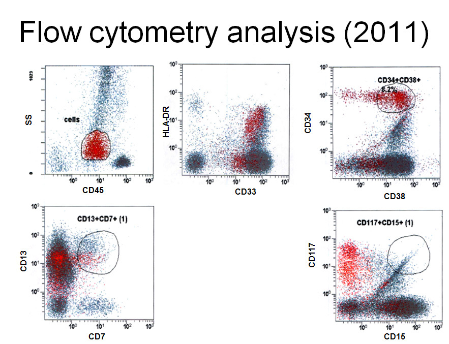 Figure 5. Immunophenotyping by flow cytometry in 2011: ~12% blasts which are positive for CD34, CD117, CD33, CD13, CD38 and HLA-DR. 